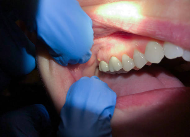 Best Emergency Care for Gum Disease in Lakemoor, IL